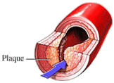 Coronary artery with Lp(a) plaque that forms when the artery is deficient in collagen from a chronic vitamin C deficiency.